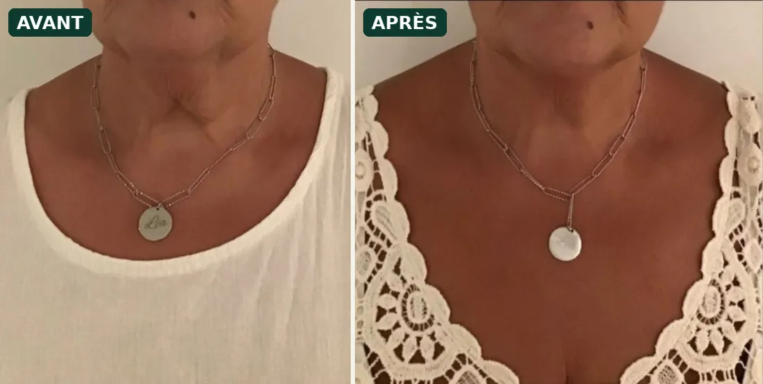 Lifting du cou sans chirurgie : avant / après HIFU sur le cou et le double menton