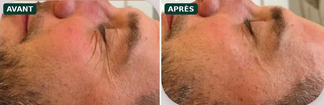 HIFU avant / après sur le regard